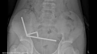 صبي يبتلع 100 مغناطيس اشتراها من "تيمو".. والشركة تعلق