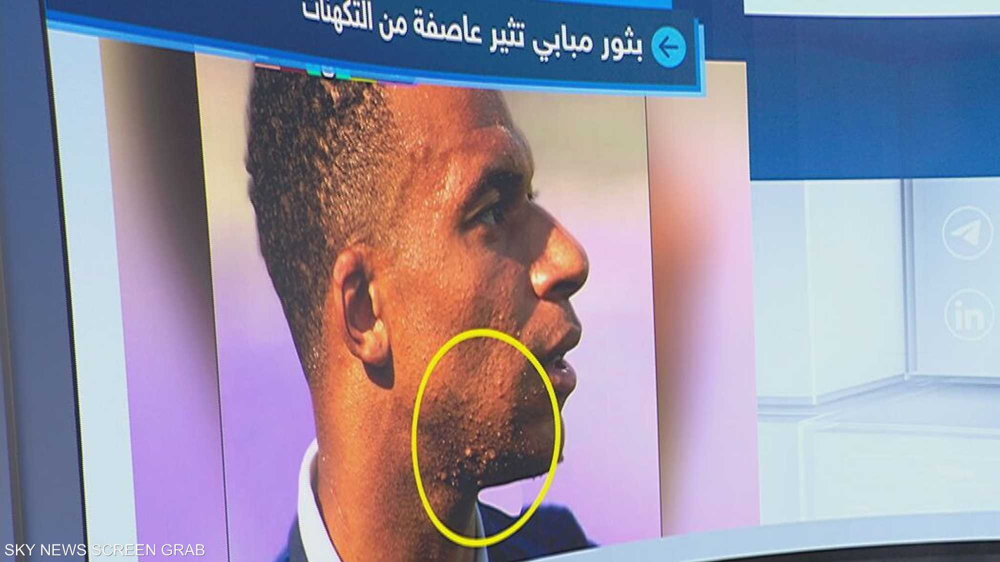 بثور مبابي.. حالة جلدية شائعة تتحول إلى موجة شائعات